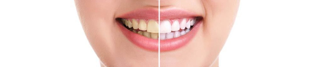 آفیس بلیچینگ مروابن Morva Bleach Office Morvabon