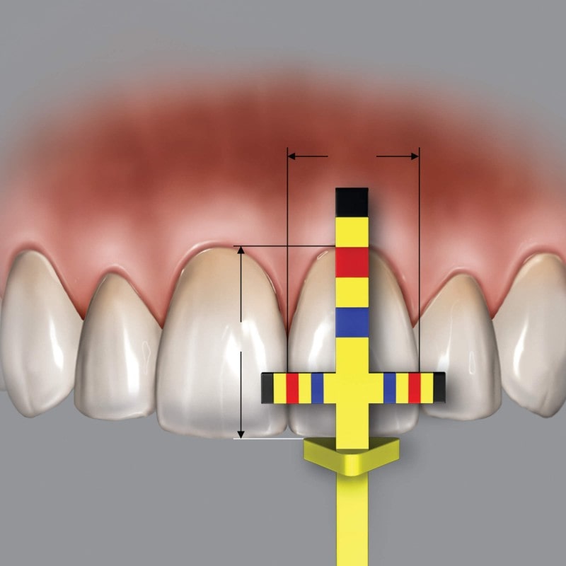 گیج صلیبی چو مدل هوفردی جهت جهت افزایش طول تاج و تسهیل در ترمیم های کامپوزیتی وینری استفاده میشود