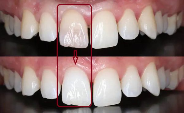 اندو بلیچ مروابن Endo Bleach Morvabon