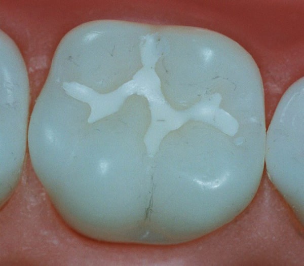 دندان که آغشته به فیشورسیلانت است