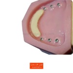 مدل تمرینی دندان اطفال پابت و متحرک نمای از پشت یکی ار ارک ها